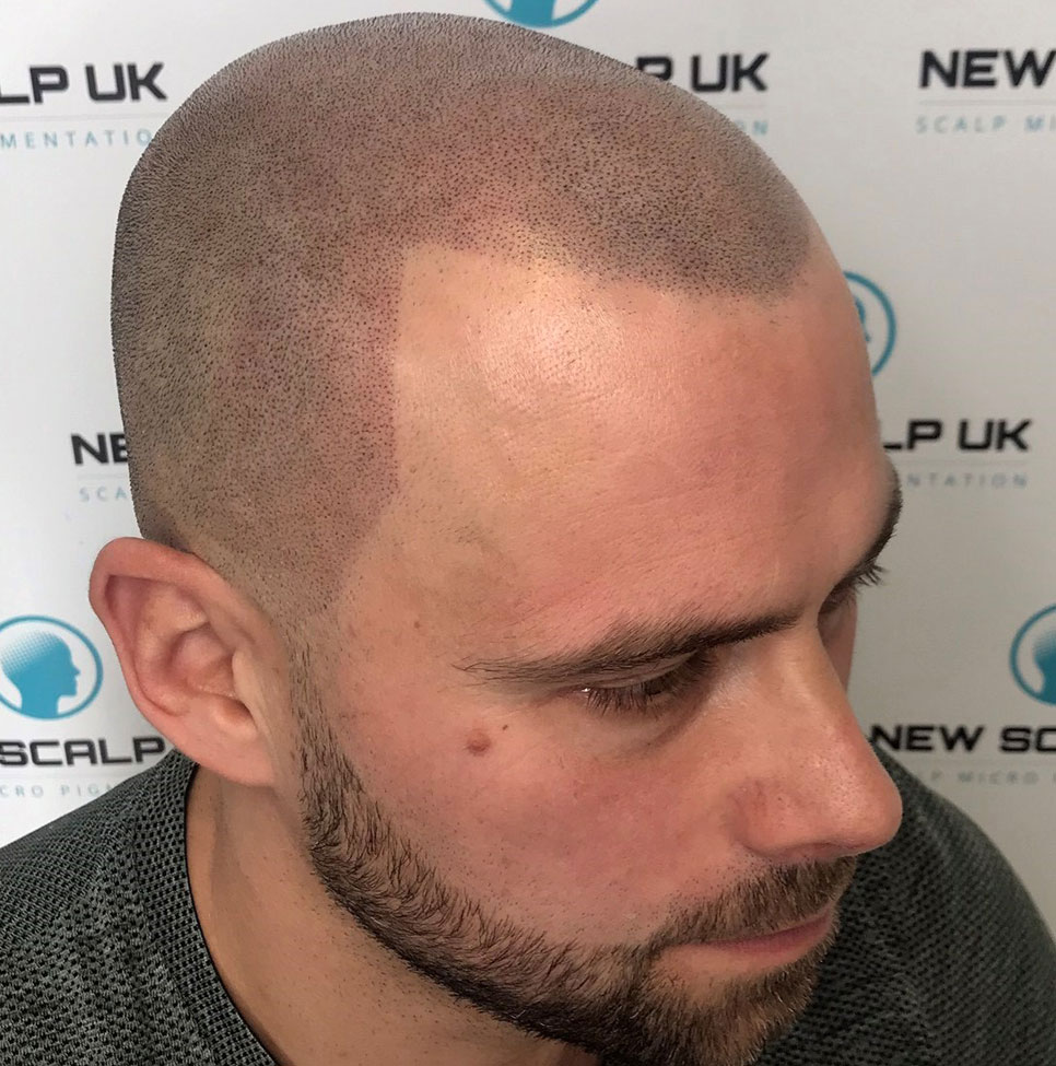 Hair Tattoo Barnsley Baldness Treatments Yorkshire New Scalp Uk