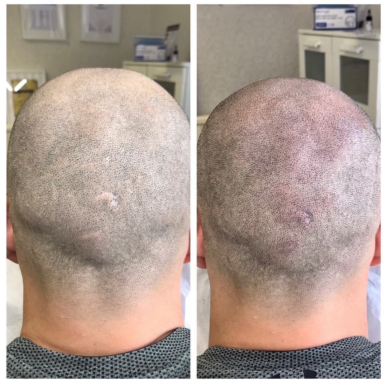 Hair Tattoo Cardiff Scalp Micropigmentation Cardiff New Scalp
